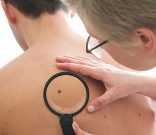 Hautkrebsuntersuchung